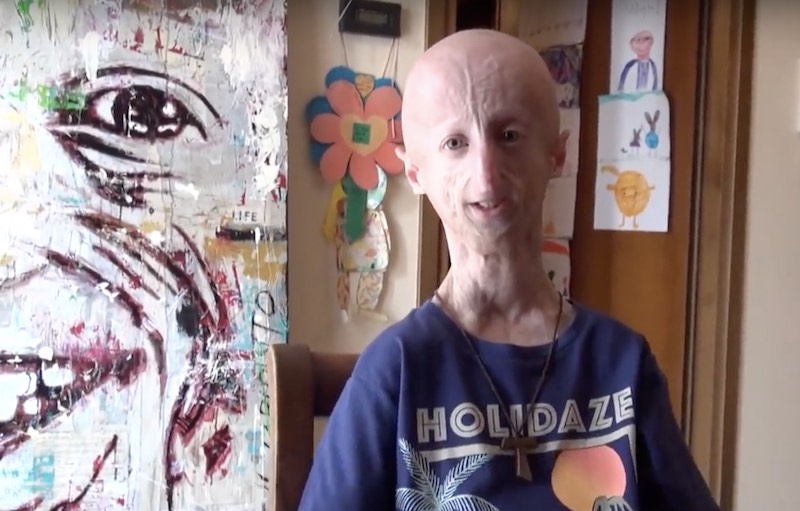 sammy-basso-progeria