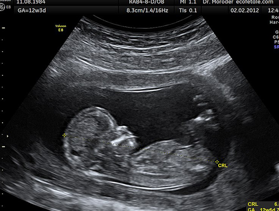 Genocidio dei bambini malati di fibrosi cistica: abortiti più del 94 per cento 1