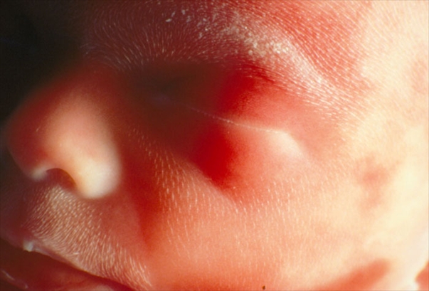 aborto