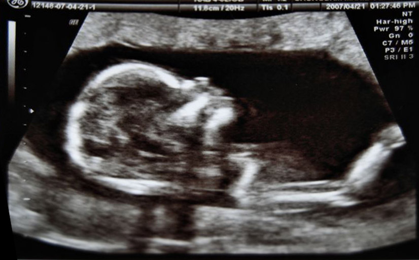 Iowa, piccoli passi pro-life: più tempo e più informazioni alle donne prima di abortire 1