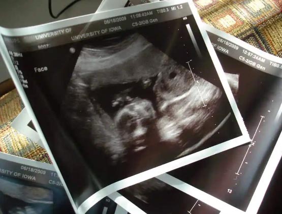 Ecco cosa accade ai bimbi che sopravvivono all’aborto 1