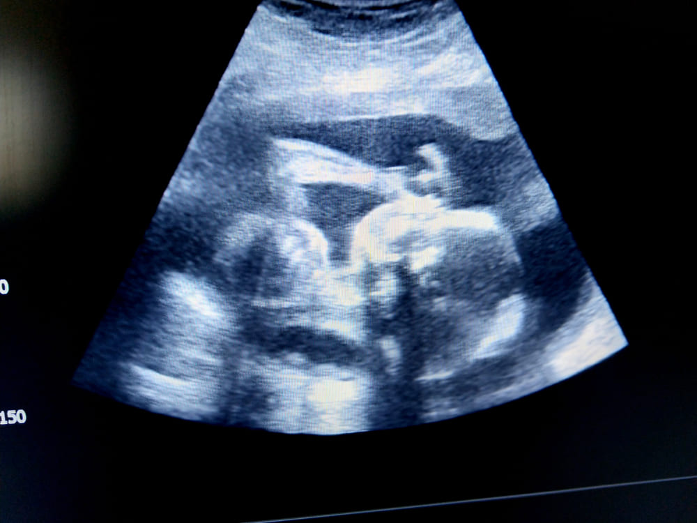 Decisione storica negli Usa. Nascituro abortito è una persona e la sua famiglia ottiene un risarcimento 1