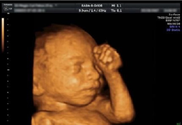 Aborto: ammazzare un bambino per una manina non ben formata 1
