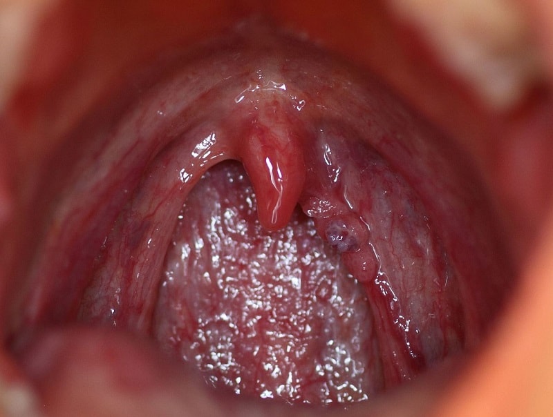 HPV_cancro_gola