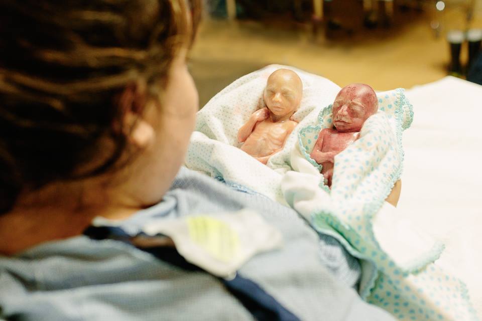Aborto – Le foto virali di due piccoli prematuri: non grumi di cellule 1