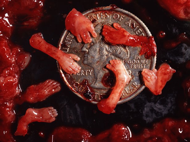 Aborto: una foto orrenda può salvare una vita 1