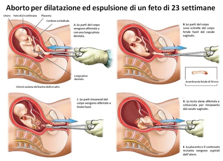 bambini_aborto_vita