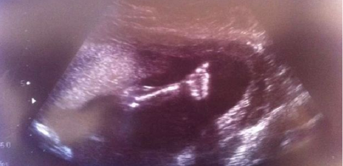 Aborto – pollice alzato delle bimba dall’ecografia: “Mamma, io ce la posso fare!” 1